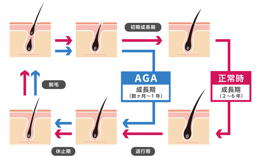 AGAのメカニズム｜神戸市のAGA・薄毛治療クリニック｜おすすめ11選