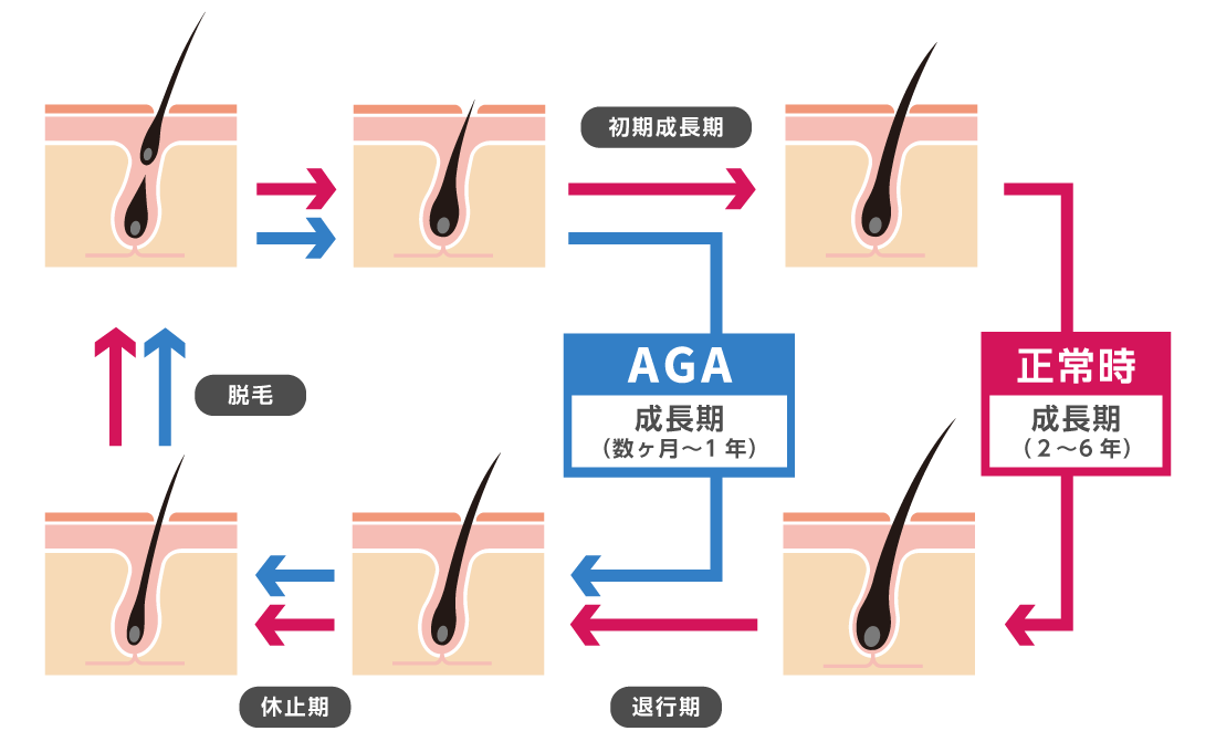 AGAのメカニズム｜札幌市のAGA・薄毛治療クリニック｜おすすめ10選