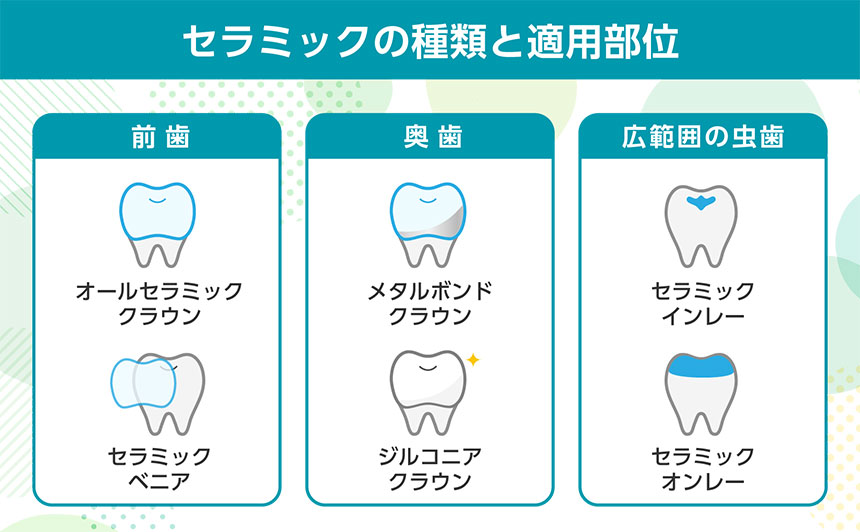 セラミックの種類と適用部位｜大阪市のセラミック治療｜おすすめ歯科クリニック16選