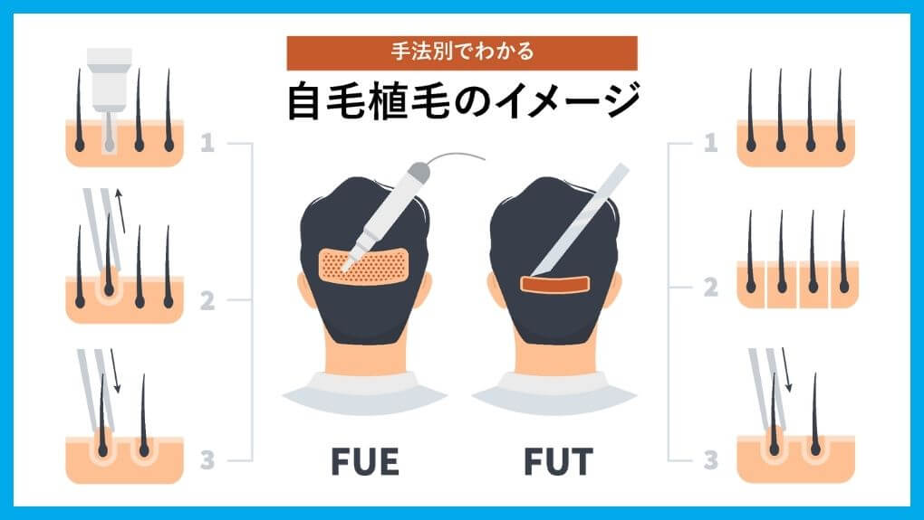 自毛植毛の手法イメージ｜大阪府の自毛植毛におすすめの人気クリニック11選