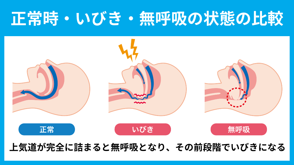 いびきの図解｜仙台市のいびき治療におすすめのクリニック5選｜治療法も紹介