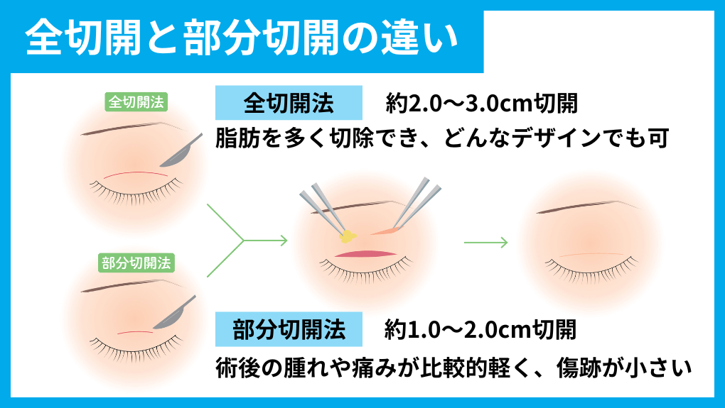 二重整形の切開法の種類解説｜東京都の二重整形｜おすすめクリニック11選＆料金目安