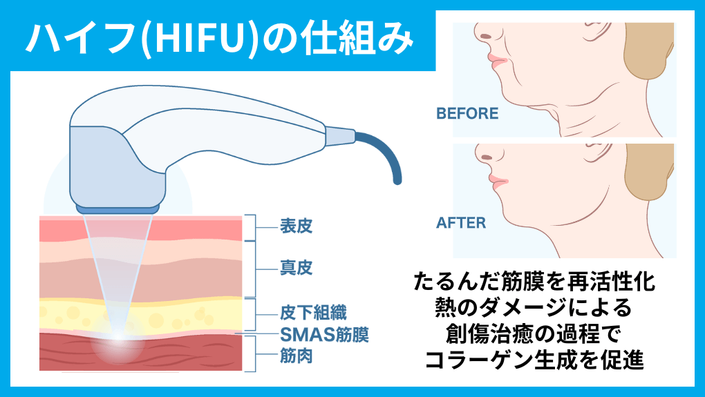 ハイフ（HIFU）の仕組み図解｜大阪市の医療ハイフ（HIFU） おすすめクリニック10選｜施術の解説も