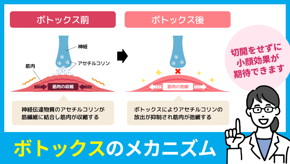 エラボトックスとは？｜千葉県のエラボトックス｜おすすめクリニック5選＆製剤ごとの特徴も解説