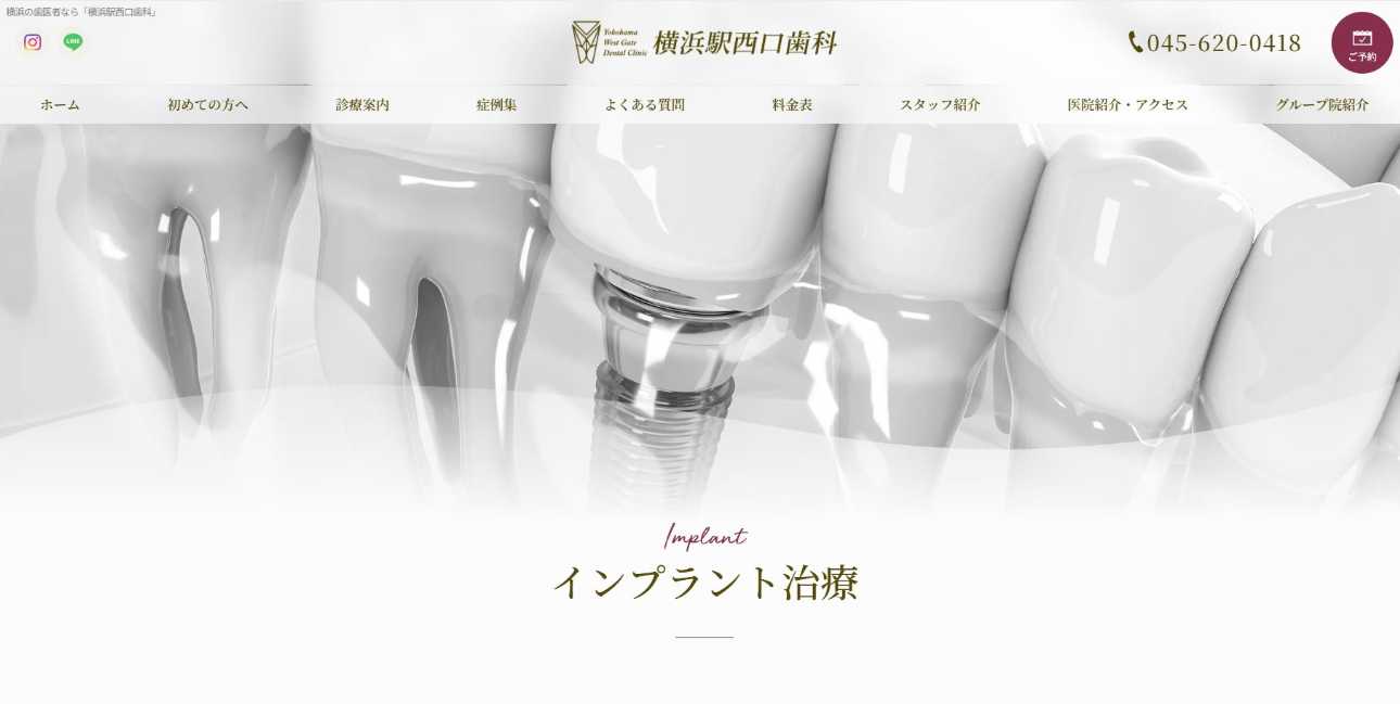横浜駅周辺のインプラント治療におすすめの歯科クリニック11選|治療の種類も解説|横浜駅西口歯科
