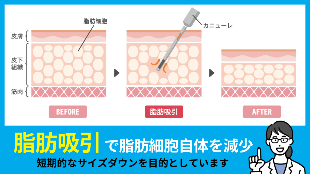 脂肪吸引でよくある質問10選|札幌市の脂肪吸引におすすめのクリニック5選|ダウンタイムについても解説